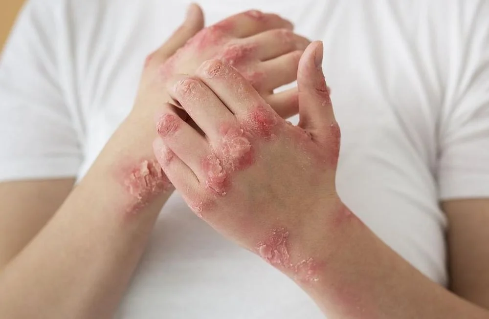 psoriasis-que-es-y-como-se-diagnostica-esta-enfermedad