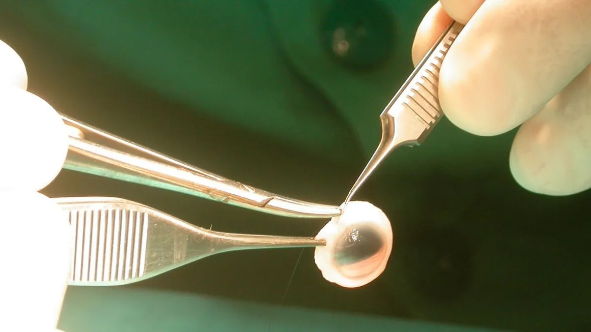 ablacion-corneas-21jpg