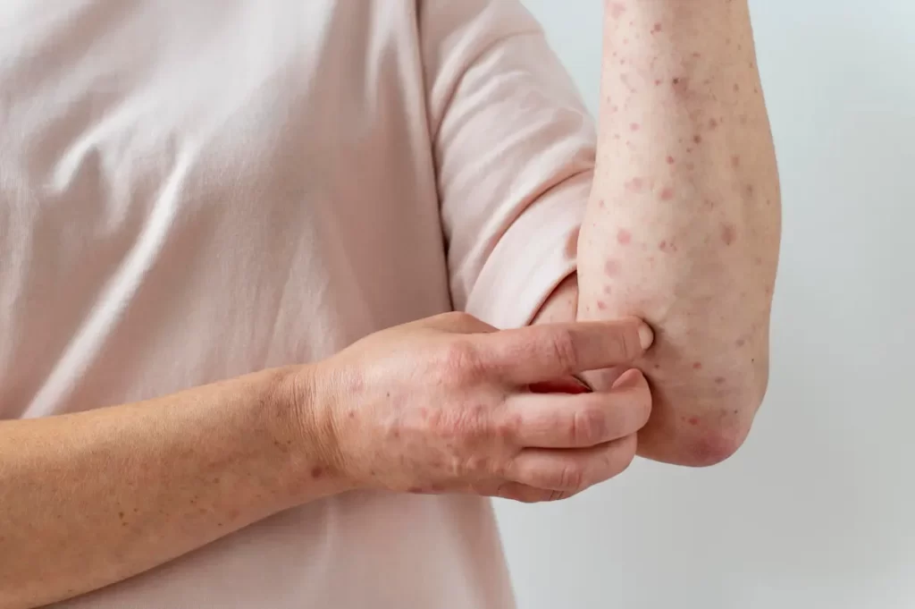 skin-allergy-on-person-s-arm-1024x681