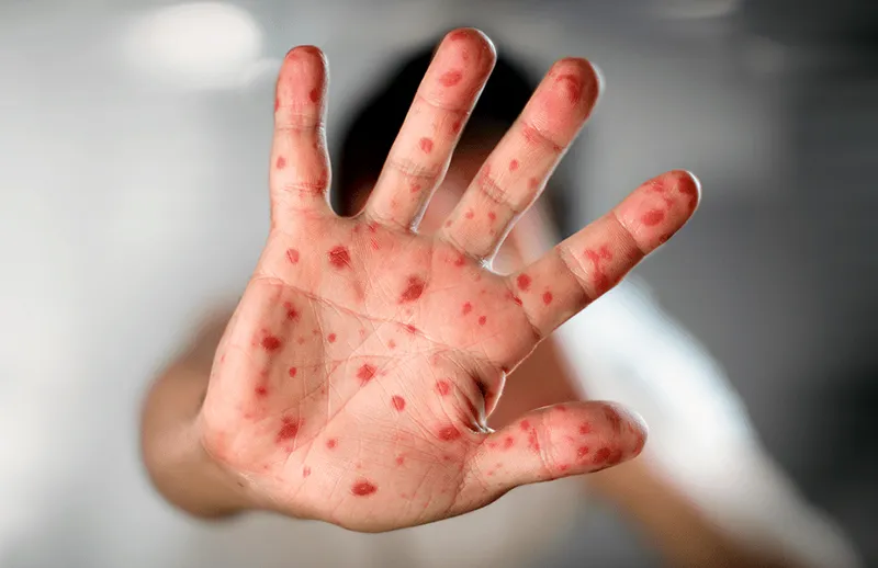 Salud-ViruelaMono-2024